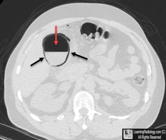 Emphysematous Cholecystitis